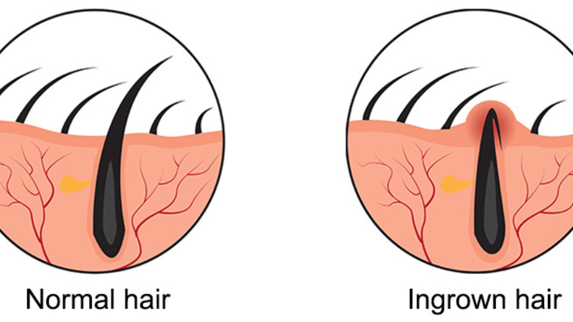 The Risks of Picking or Squeezing Ingrown Hair: Why You Should Avoid It?